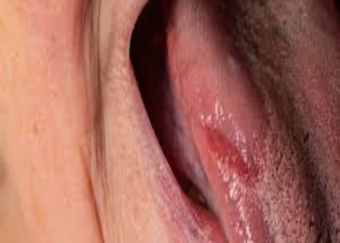 बर्निंग माउथ सिंड्रोम से प्रभावित हो सकते हैं स्वाद कलिकाएं, सूखा रहता है मुंह; जानें इस बीमारी का इलाज