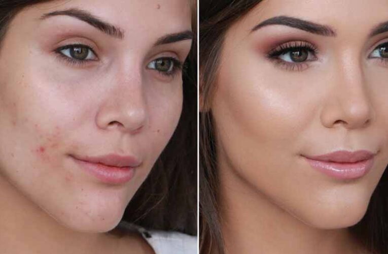ब्लैकहेड्स वाले चेहरे पर ऐसे करें मेकअप