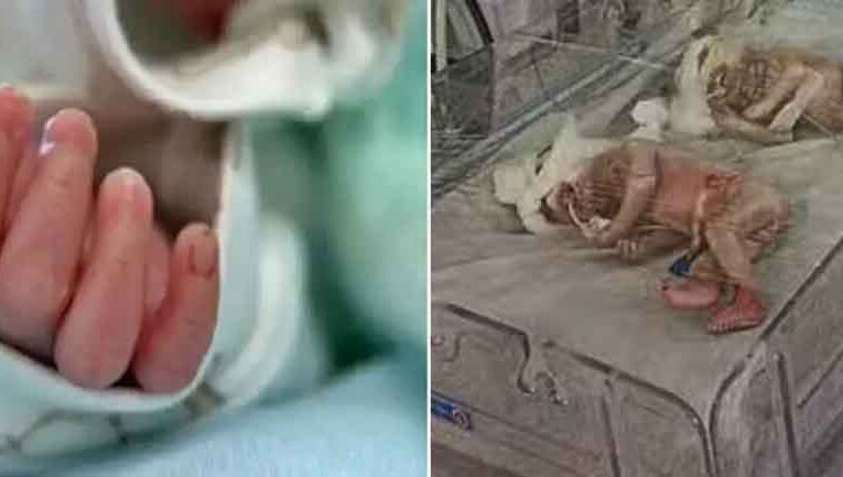 राजस्थान-बीकानेर के अस्पताल में जन्मे एलियन जैसे बच्चे, परिजन से लेकर डॉक्टर भी हैरान