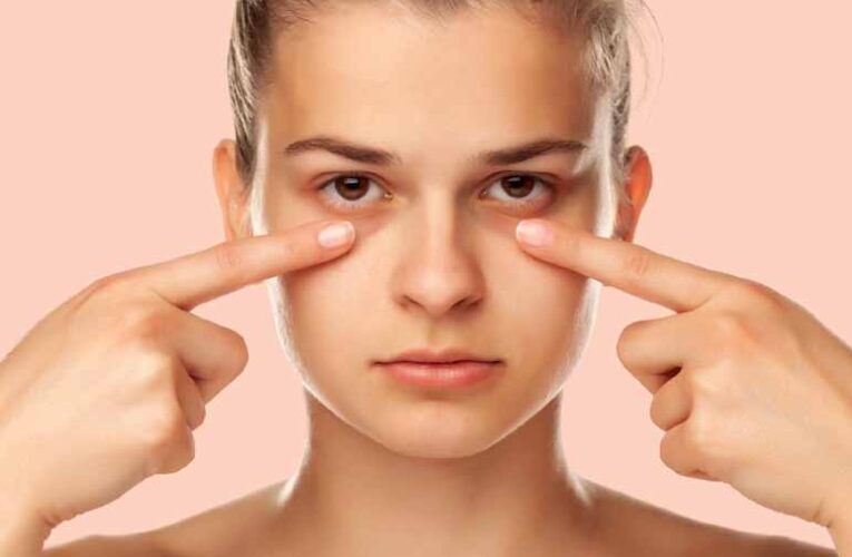 आंखों के नीचे डार्क सर्कल खत्म करने के घरेलू और असरदार उपाय