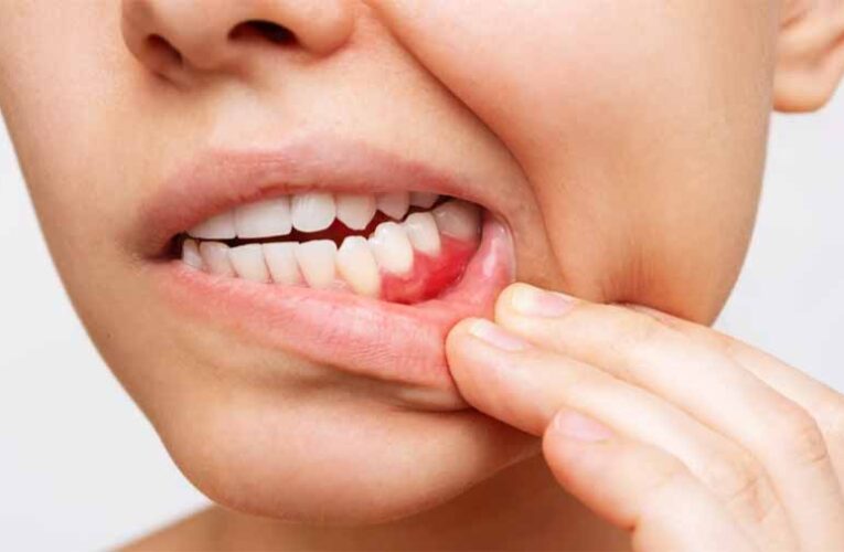 दांत-मसूड़ों के दर्द से छुटकारा पाने में काम आएंगे ये घेरलू उपाय