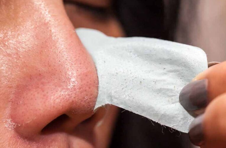 नाक के ऊपर जमे ब्लैकहेड्स घर पर ही इन तरीकों से करे साफ