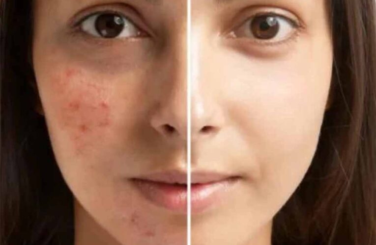 चेहरे से दाग-धब्बे और पिंपल्स गायब करेगी ये रेमेडी
