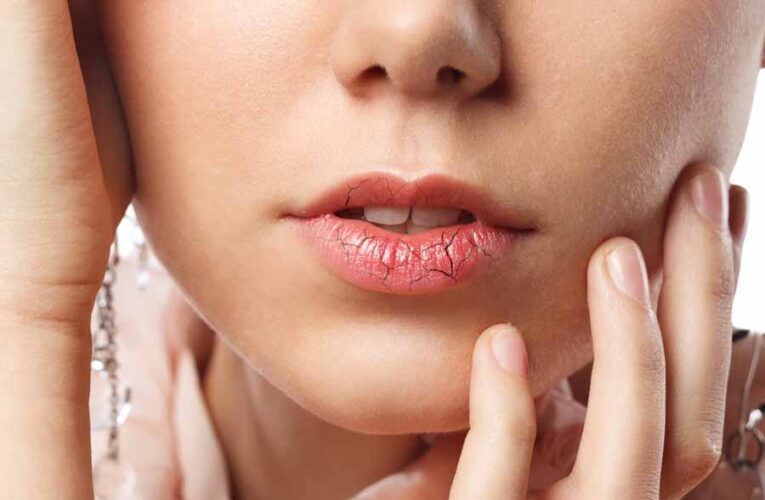 सर्दी के मौसम में  फटने लगते हैं हमारे होंठ, घर पर तैयार करें लिप बाम
