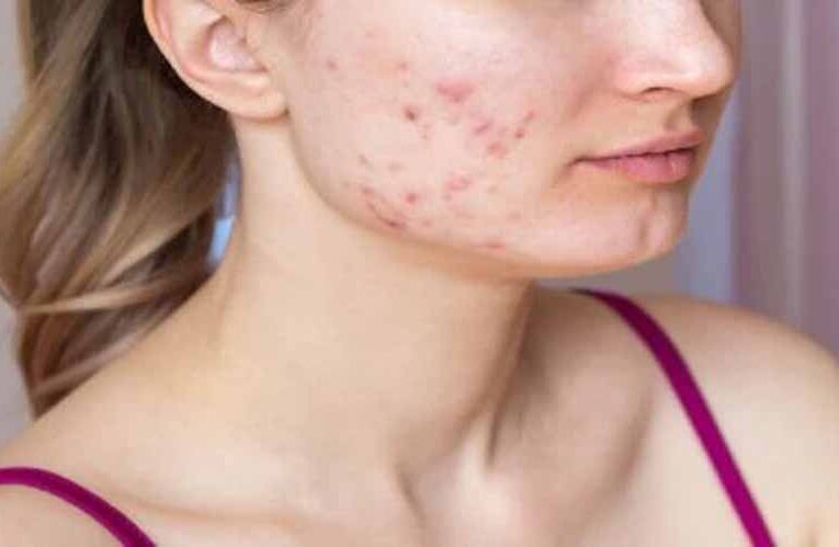 पिम्पल्स बढ़ा सकते हैं ये फूड्स, आज ही करें बंद