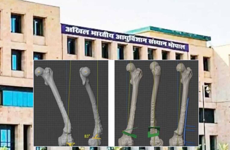 भोपाल एम्स ने हासिल की एक और बड़ी उपलब्धि, 3 डी प्रिंटिंग तकनीक से होगा हड्डी रोग का निशुल्क इलाज