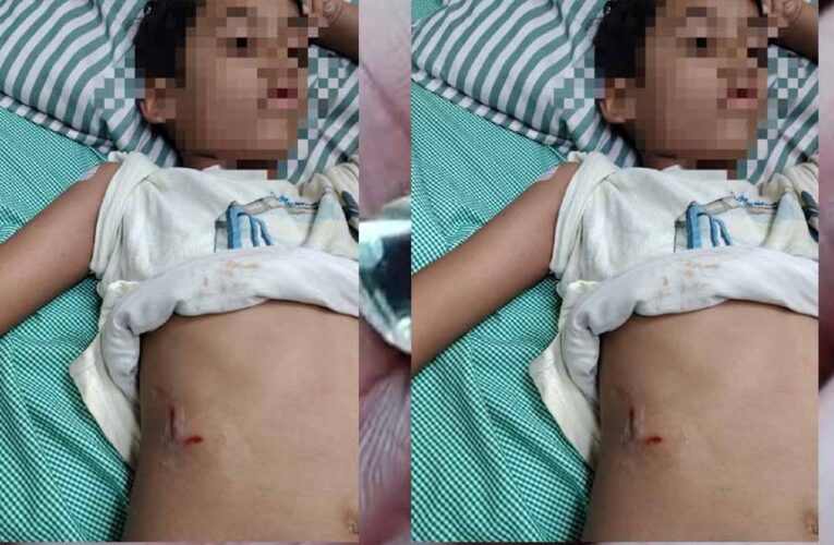 पेबल बे फेस 1, बागमुगलिया कटारा हिल्स में आवारा कुत्ते ने बच्चे को काटा