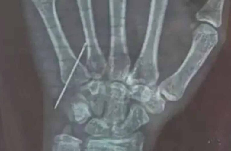 गोरखपुर में डॉक्टर की लापरवाही: 15 साल की बच्ची की नस में तोड़ा नीडल, CMO ने जांच के आदेश दिए