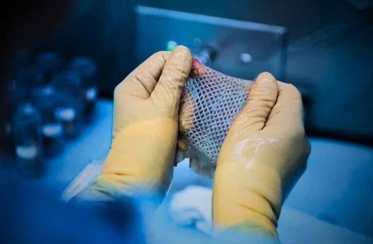 विन्ध्य क्षेत्र में पहली बार हुआ स्किन डोनेशन