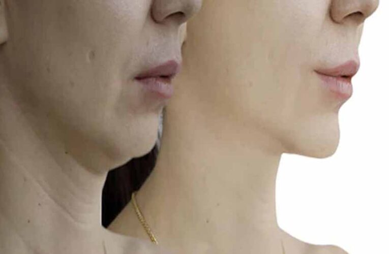 सिर्फ 5 मिनट में हटाएं गर्दन की झुर्रियाँ – उम्र बढ़ने पर भी बनी रहे स्किन टाइट