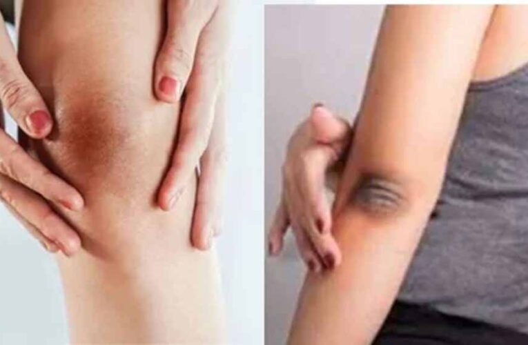 ऐसे दूर करें कोहनी और घुटनों के कालेपन को