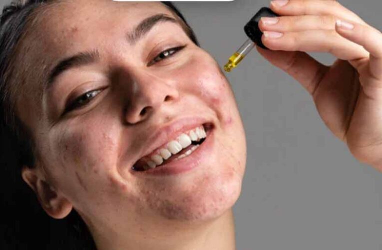 सैलिसिलिक एसिड का कमाल! पिंपल्स और दाग-धब्बों से मिलेगा झटपट छुटकारा
