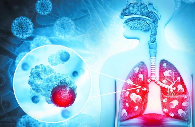 हर 9 में से 1 भारतीय को कैंसर का खतरा, पुरुषों में फेफड़े और महिलाओं में ब्रेस्ट कैंसर सबसे ज्यादा