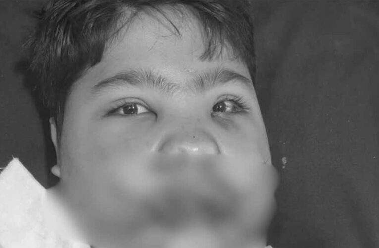 MP में फ्रिज फटा: मासूम की 108 हड्डियां टूटी, डॉक्टरों ने 5 घंटे में लौटाई जिंदगी