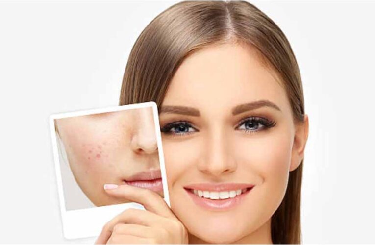 हरे के दाग-धब्बों और पिगमेंटेशन को करे मात, चावल का यह घरेलू नुस्खा आजमाएं!