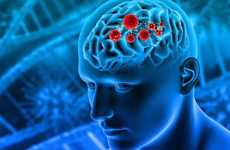 ब्रेन ट्यूमर के शुरुआती संकेत: अपने शरीर के ये अलर्ट कभी न करें नजरअंदाज