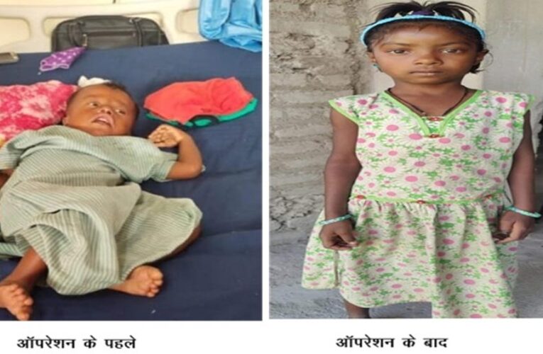 रायपुर : चिरायु योजना बच्चों के लिए भी बनी वरदान