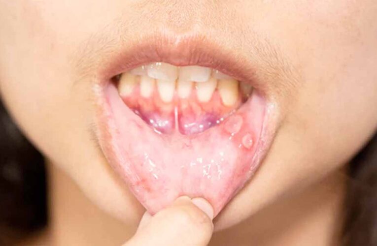 मुंह के छालों से राहत पाने के आसान और असरदार घरेलू उपाय