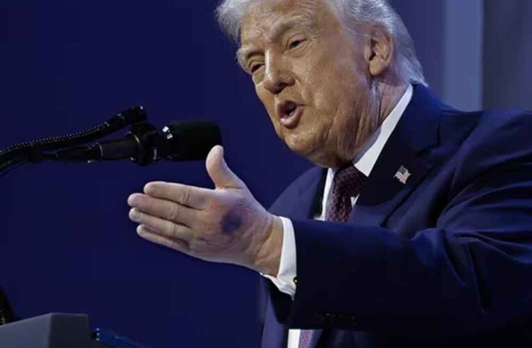 ट्रंप के हाथ पर नीले निशान क्यों? ‘बीमारी’ की अटकलों पर राष्ट्रपति ने खुद तोड़ी चुप्पी