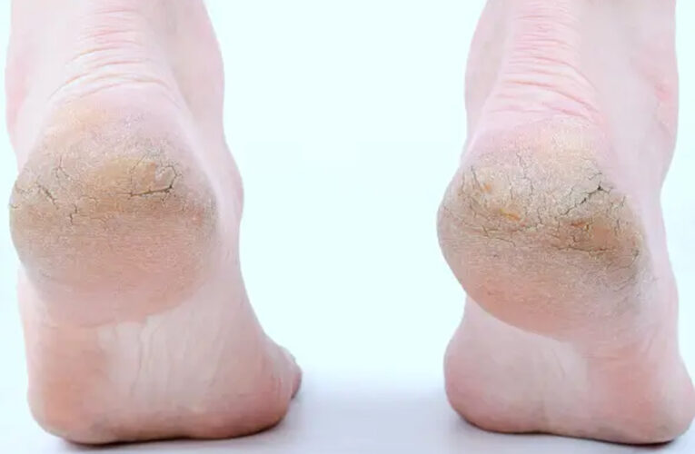 फटी एड़ियों की छुट्टी! 6 घरेलू नुस्खों से पाएं मक्खन जैसी मुलायम एड़ियां
