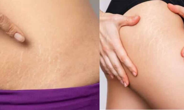 घर बैठे ऐसे मिटाएँ जिद्दी स्ट्रेच मार्क्स, बिना महंगे इलाज के