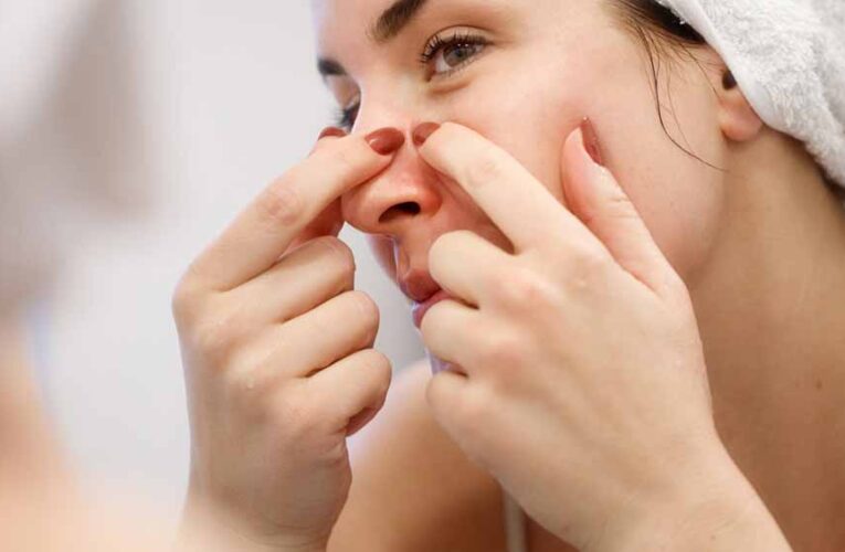 पिंपल्स फोड़ना पड़ सकता है भारी, चेहरा खराब होने और इन्फेक्शन का बढ़ता है खतरा