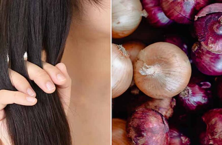 प्याज का तेल: हेयर फॉल रोकने का घरेलू नुस्खा