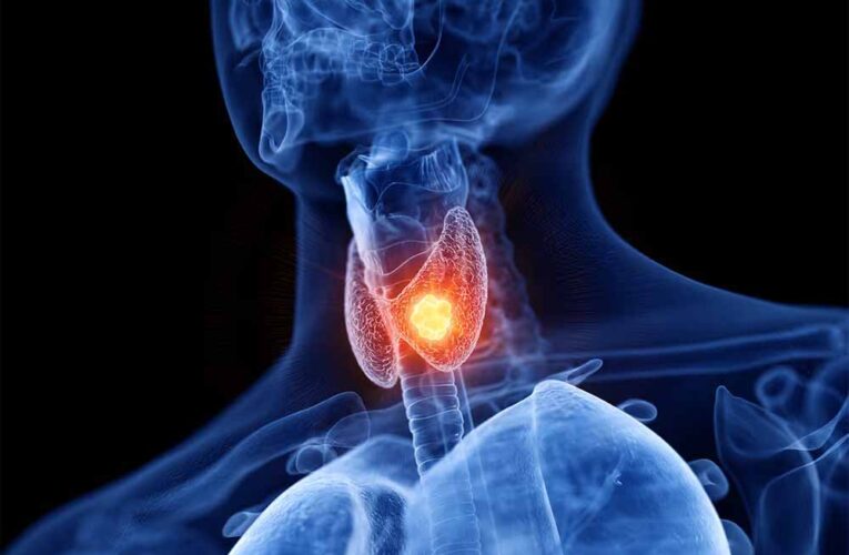 थाइरॉएड के मरीज क्यों न खाएं शुगर और सोया? जानें कारण