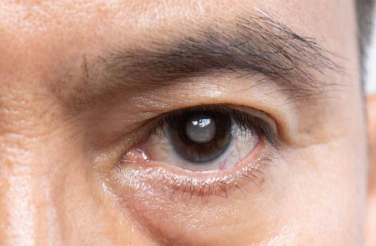 साइलेंट चोर ‘ग्लूकोमा’ से सावधान! आंखों में दिखें ये संकेत तो तुरंत कराएं जांच