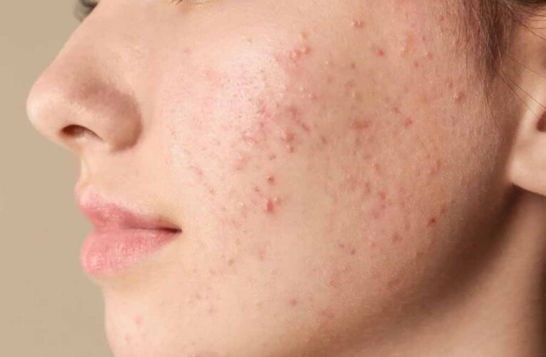 बार-बार पिंपल्स निकल रहे हैं? ये सिर्फ गंदगी नहीं, अंदर छिपी इन बीमारियों का हो सकता है संकेत