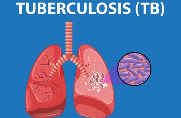 कमजोर इम्युनिटी और खराब लाइफस्टाइल से बढ़ता टीबी का खतरा, जानें लक्षण और बचाव के उपाय