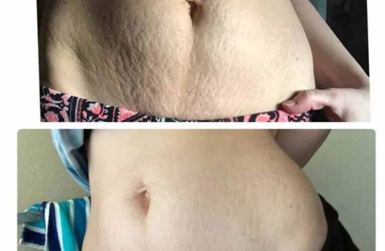 घर बैठे जिद्दी स्ट्रेच मार्क्स हटाने के आसान और असरदार तरीके