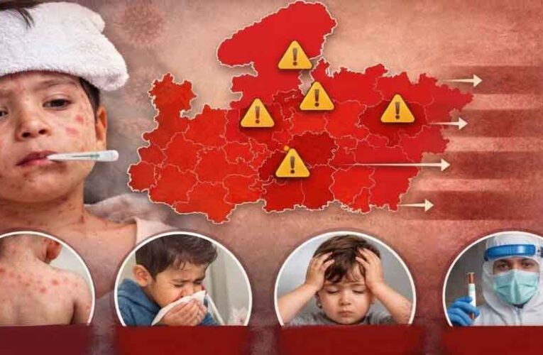 MP में खसरे की एंट्री: 4 जिलों में 12 नए मरीज, स्वास्थ्य विभाग अलर्ट मोड पर; घर-घर सर्वे शुरू