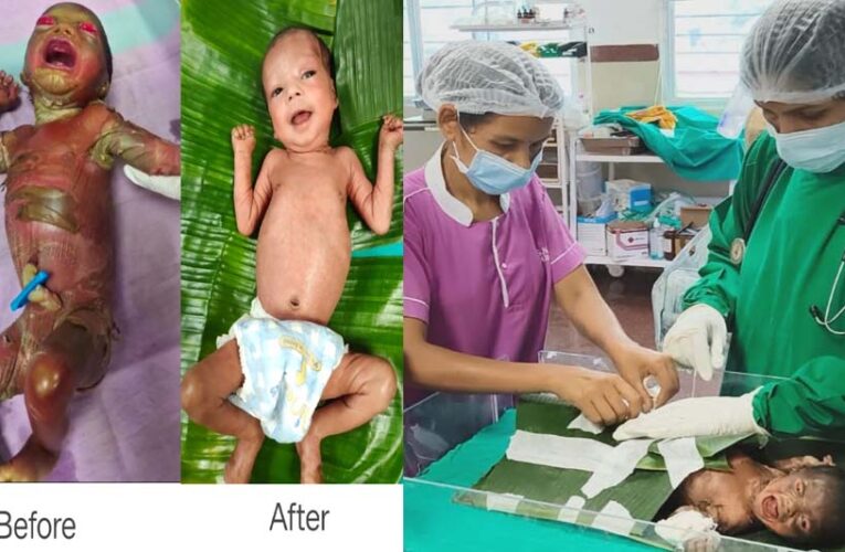 अत्यंत दुर्लभ बीमारी से जूझ रहे नवजात को बीजापुर जिला अस्पताल की SNCU में मिला नया जीवन