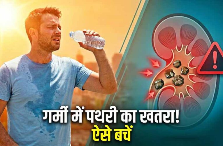 गर्मी में बढ़ा किडनी स्टोन का खतरा, डिहाइड्रेशन बन रहा बड़ा कारण