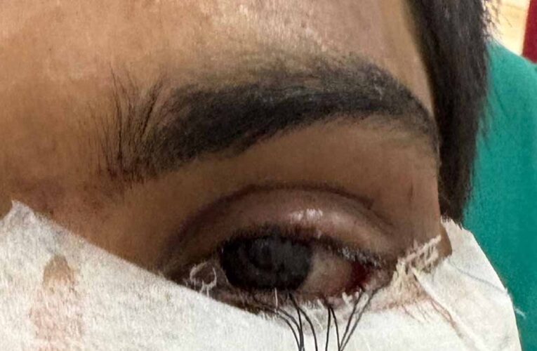 स्किन ग्राफ्टिंग से मरीज के पलक का सफल पुनर्निर्माण