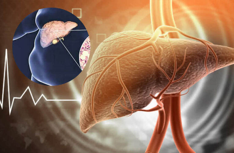 Fatty Liver को न करें नजरअंदाज! बढ़ सकता है हार्ट अटैक का खतरा, दिखें ये लक्षण तो तुरंत जाएं डॉक्टर के पास
