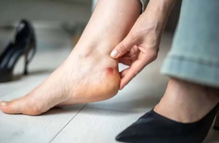 नए जूतों के छालों से राहत देंगे ये घरेलू नुस्खे, दर्द होगा दूर