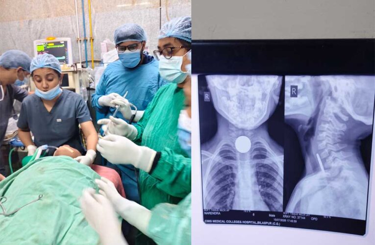 6 वर्षीय मासूम की आहार नली से सफलतापूर्वक निकाला गया सिक्का, बची जान