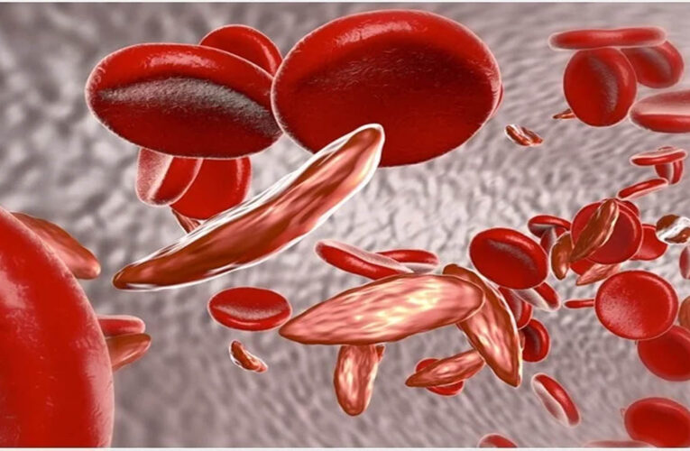 Sickle Cell Disease: देश के 59% मरीज ओडिशा और MP में मिले, 7.27 करोड़ लोगों की हुई जांच